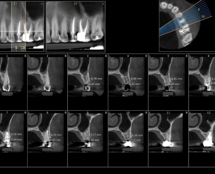 اسکن CBCT