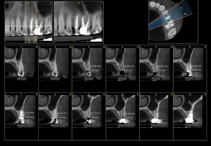 اسکن CBCT